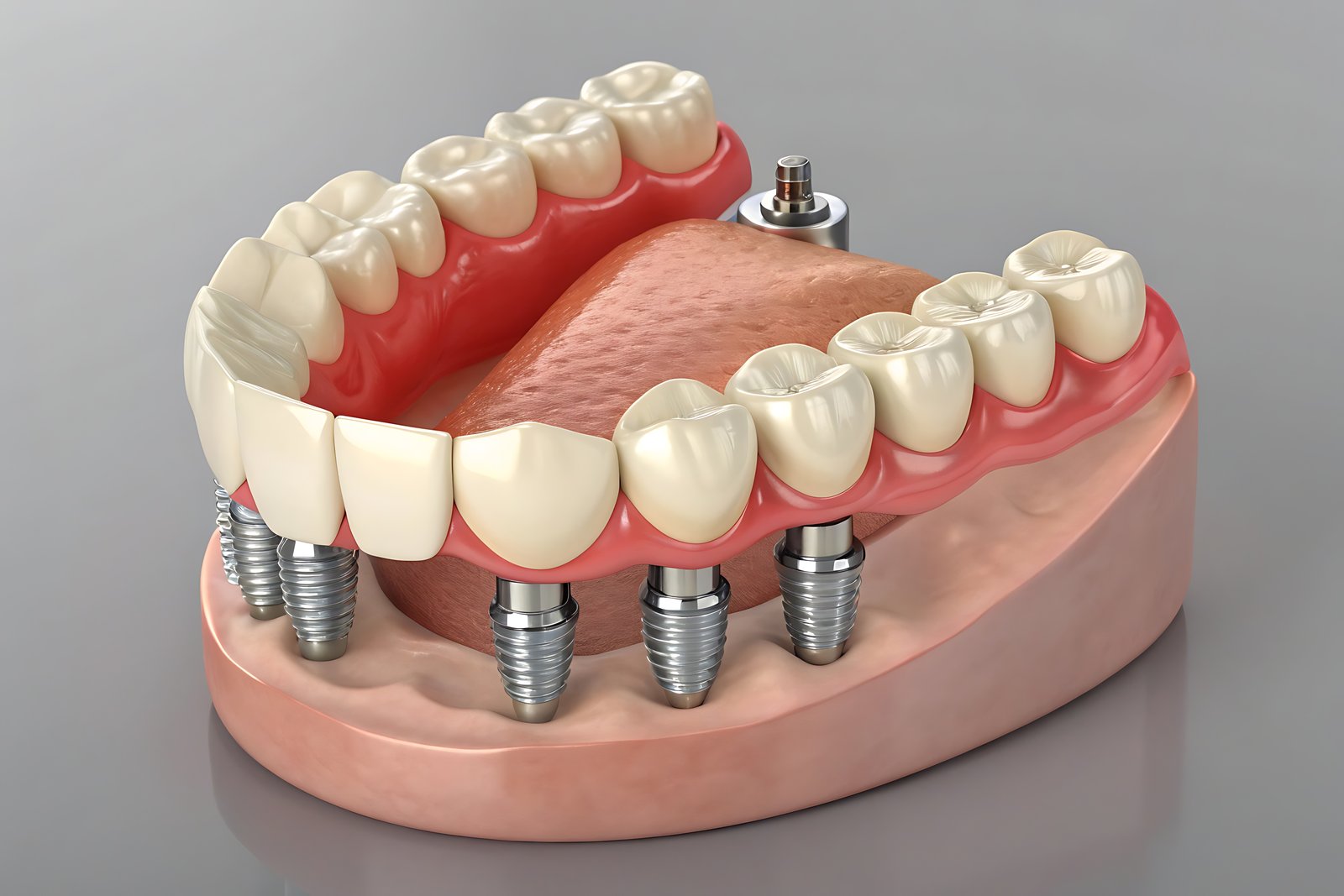 Implant Supported Dentures